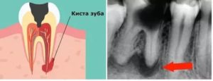 Боли после удаления зуба с кистой