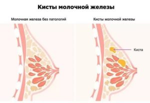 Болит грудь после откачивания кисты