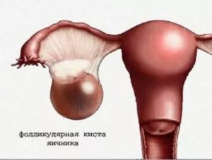 Киста правого яичника и задержка