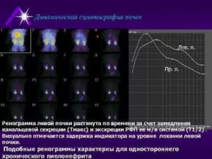 Неравномерное распределение РФП при проведении динамической сцинтиграфии почек