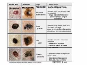 Может ли меланома быть доброкачественной
