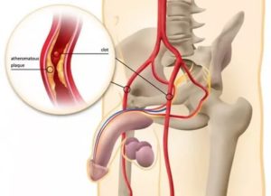 Нестабильность в эрекции и глубокое проникновение