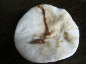 Кровянистые и мажущие выделения после удаления миомы