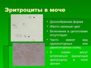 Повышены эритроциты в моче