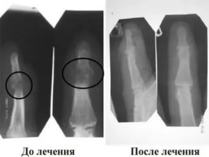 После перелома носа образовалась костная мозоль