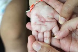 Непроходящая чесотка у ребенка
