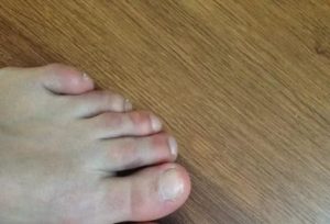 Ушиб указательного пальца ноги