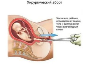 Беременность после хирургического аборта спустя 3 месяца