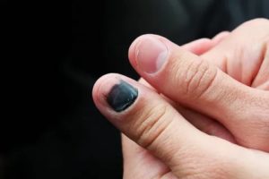 Красная точка под ногтем руки не травма болит куда обращаться