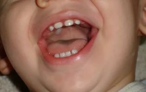 Прорезывание первого зуба не по порядку