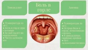 Боль в горле без температуры