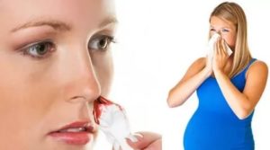 Кровь из носа при беременности