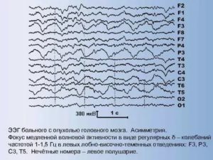 Расшифровка ЭЭГ. ВГСД. Опухоль