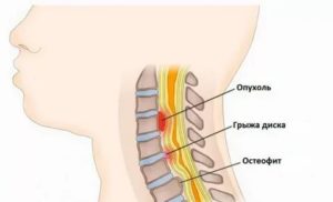 Душит горло. Грыжа шейного отдела