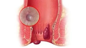 Ранка на геморроидальном узле