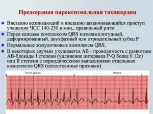 Хроническая тахикардия после испуга