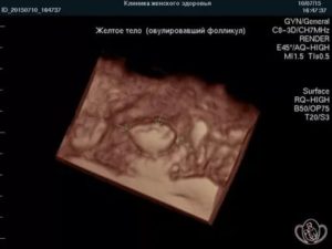 Узи 20 день цикла желтое тело