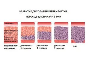 Дисплазия шейки матки 1 степени при планировании беременности