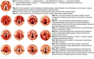 Кашель 2 месяца после стеноза гортани