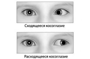 Косоглазие после операции какие можете дать рекомендации