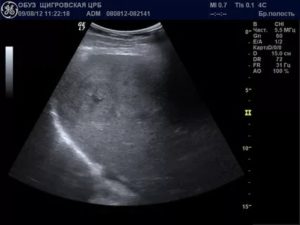 Затемнение в почке