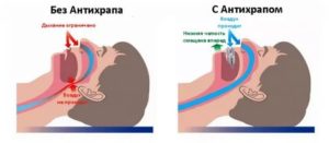 Закладывает нос во время сна