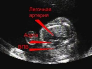 Гипоплазия восходящей аорты на 32 неделе беременности