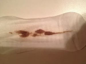 Коричневые выделения у девственницы