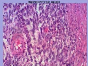 Веретеноклеточная злокачественная опухоль