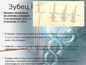 Зубец R в 4 отведении