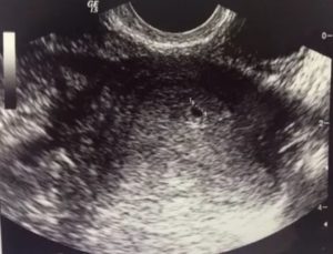 Кровотечение после узи