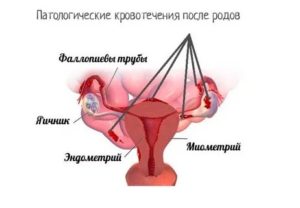 Кровотечение через месяц после родов