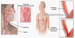 Кандидоз пищевода