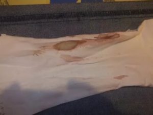 Кровянистые выделения 3 недели