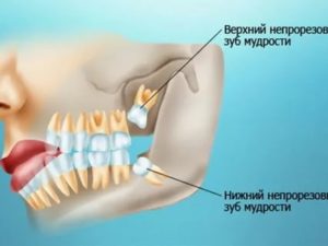 Боль от зуба мудрости или нет?