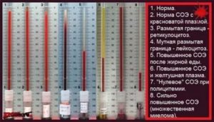 Высокое СОЭ и температура после операции