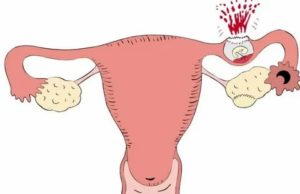 Как быстро забеременеть после внематочной беременности