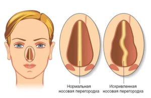 Заложенность носа при искривлении носовой перегородки