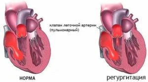 Дисфункция клапана легочной артерии