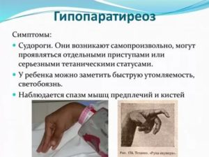 Гипопаратиреоз