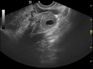 Киста правого яичника и задержка