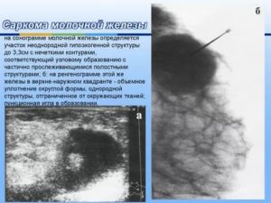 Неоднородная ткань молочных желез