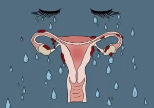 Эндометриоз и низкий прогестерон