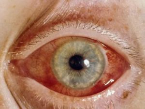 Послеоперационное воспаление глаза