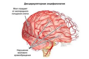Энцефалопатия
