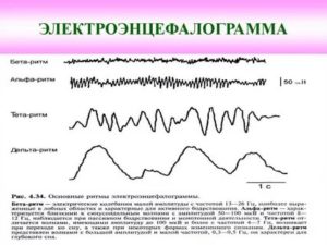 Расшифровать результаты ЭЭГ, РЭГ