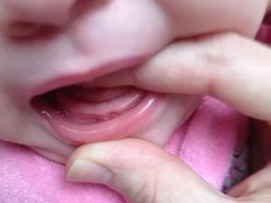 Прорезывание первого зуба не по порядку
