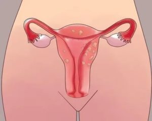 Кровотечение после пропуска ОК Медиана