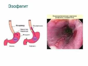 Лечение рефлюкс эзофагит 2 степени