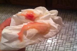 Коричневые выделения, лечение от молочницы